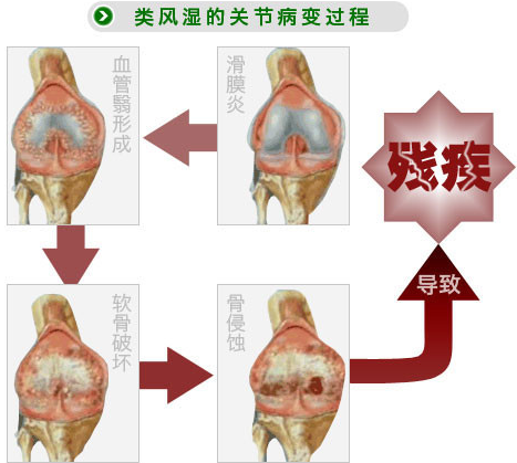 行动的枷锁 病痛的折磨—类风湿性关节炎深度剖